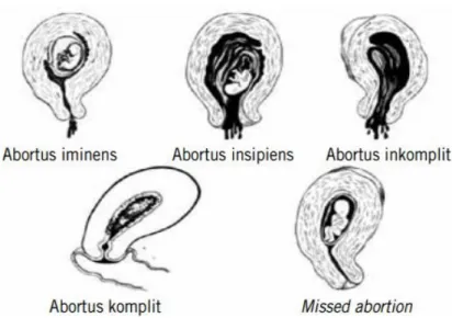 Gambar 4.4 Kriteria diagnosis abortus Sumber: Sinopsis Obstetri, edisi 2