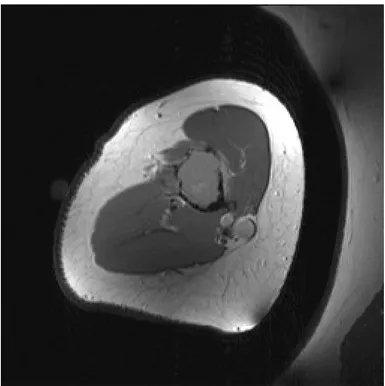 Gambar 8. T1 weighted-MRI dari humerus. Gambaran ini memperlihatkan lesi   myelomatosa   yang   predominan   hipointens   hingga   isointens   pada medulla dari diafisis