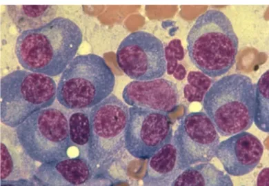 Gambar 9.  Aspirasi sumsum tulang memperlihatkan sel-sel plasma multiple myeloma.  Tampak   sitoplasma   berwarna   biru,   nukleus   eksentrik,   dan   zona pucat perinuclear (halo)