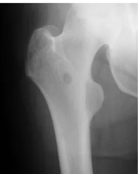 Gambar 5. Gambaran radiologi pada os femur dekstra. Tampak gambaran khas suatu lesi myeloma tunggal berupa gambaran lusen berbatas tegas pada regio interocanter