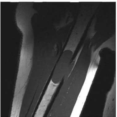 Gambar   7.   Foto   potongan   koronal  T1   weighted-MRI    pada   suatu   lesi myeloma di humerus