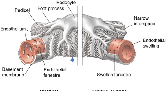 Gambar 3. Endoteliosis kapiler glomerulus