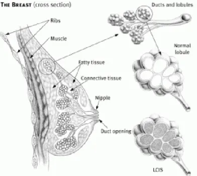 Gambar 1.12 Ductal Carcinoma in situ (A) dan Sel-sel kanker menyebar keluar dari ductus,  menginvasi jaringan sekitar dalam mammae (B)