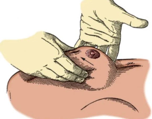 Gambar 1.5. Dumpling of the breast, akibat dari terlibatnya ligamentum Cooper pada penyakit yang  invasive