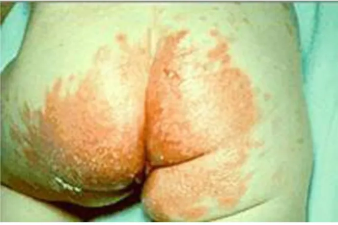 Gambar 7: kandisosis intergluteal