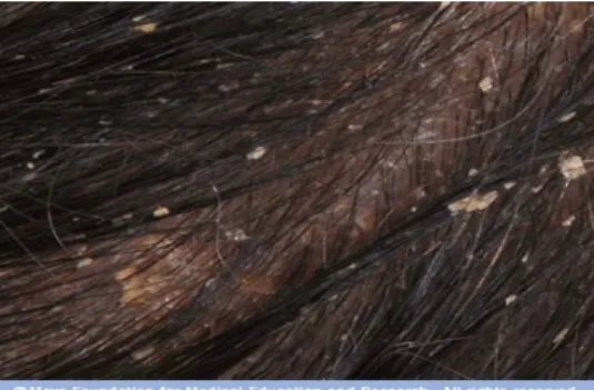 Gambar 1 : Pitiriasis sika (ketombe/dandruff)