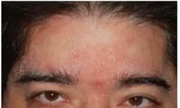 Gambar 2 : Dermatitis Seboroik di kepala dan alis