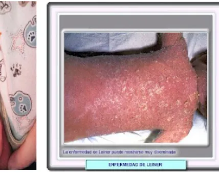 Gambar 4 : Leiner’s Disease Sumber : 