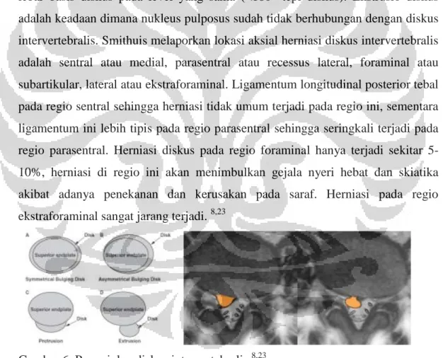 Gambar 6. Penonjolan diskus intervertebralis  8,23