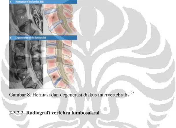 Gambar 8. Herniasi dan degenerasi diskus intervertebralis  25
