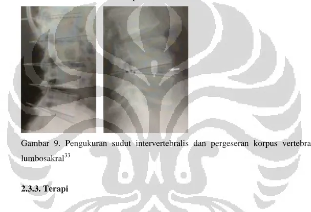 Gambar  9.  Pengukuran  sudut  intervertebralis  dan  pergeseran  korpus  vertebra  lumbosakral 33