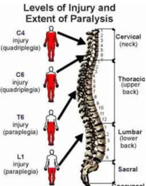 Gambar 5 : manifestasi plegi pada trauma medulla spinalis  (6)  Dislokasi  bisa  ringan  dan  bersifat  sementara  atau  berat  dan  menetap