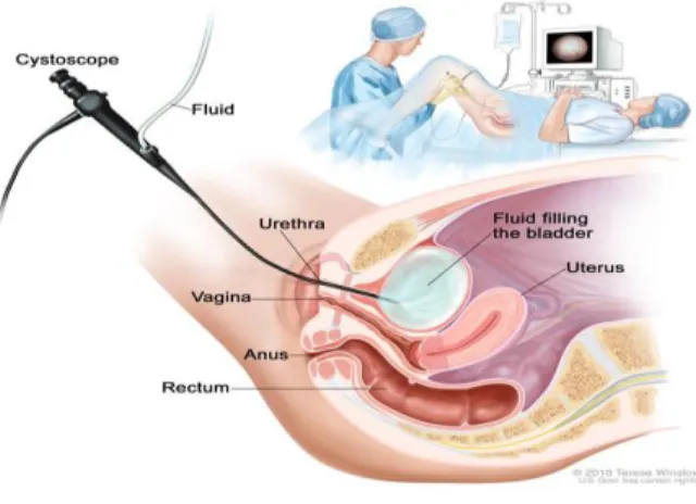 Gambar 3. Cystoscopy 
