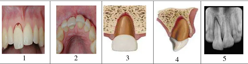Gambar 14.  Avulsion (1) Tampak depan, (2) Tampak oklusal, (3) Tampak depan animasi, (4) Tampak  lateral animasi,  (5) Gambar radiografi.22 