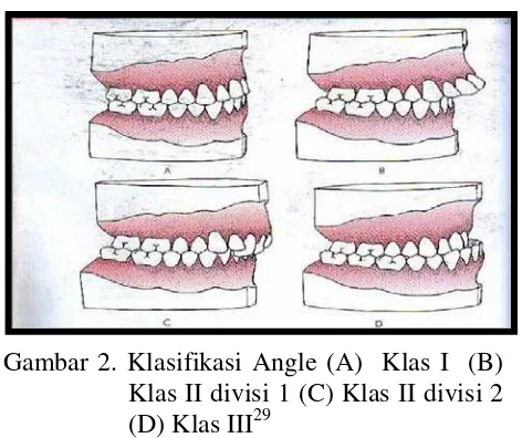 Gambar 2. Klasifikasi Angle (A)  Klas I  (B) 