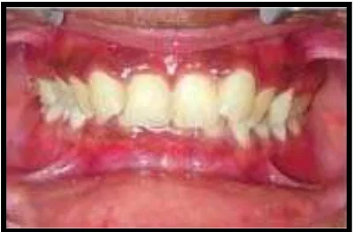 Gambar 6. Dental Deepbite36 