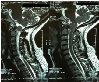 Gambar 2.  MRI Cervikal dengan KontrasGambar 1. MRI Cervikal tanpa Kontras