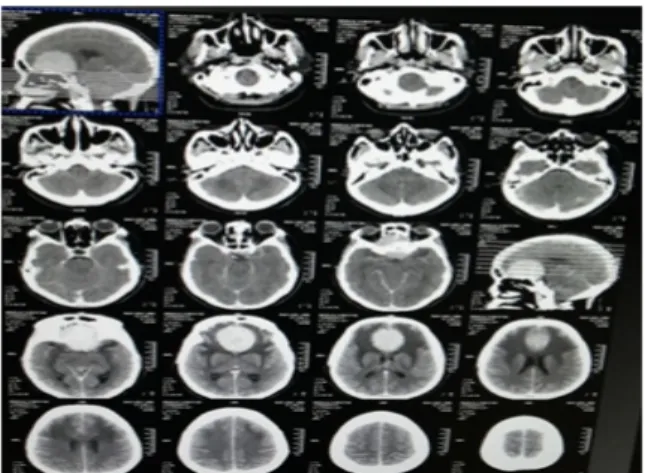Gambar 2. Hasil CT-scan Non Kontras setelah  Dilakukan Operasi