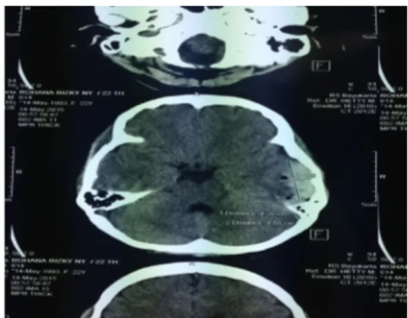 Gambar 1. Foto Ct-Scan Kepala