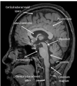Gambar 2b. Sistem ventrikel yang melebar pada usia tua.