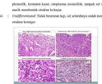 Gambar 2.7.1  Differensiasi sel Adenokarsinoma (National Cancer Center 