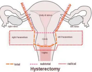 Gambar 4. Macam Histerektomi ( www.medscape.com)