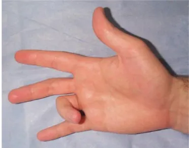 Gambar 5. Trigger Finger Digiti IV 