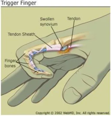 Gambar 2. Trigger finger 