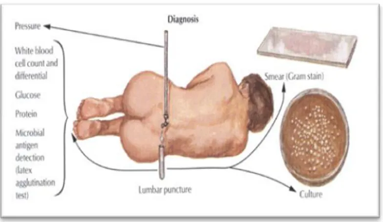 Gambar 2.8  Pemeriksaan lumbal pungsi 