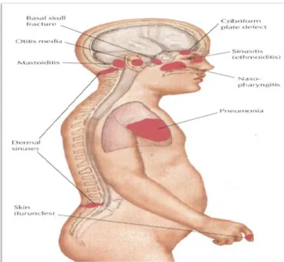 Gambar 2.3 Port of entry bakterial meningitis 