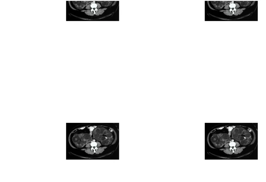 Gambar CT scan menunjukkan kista luas di kedua ginjal, kista telah hampir sepenuhnya menggantikan parenkim ginjal.