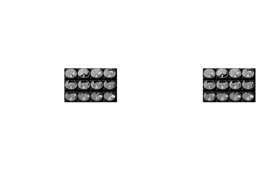 Gambar CT axial tanpa kontras pada tumor Wilms