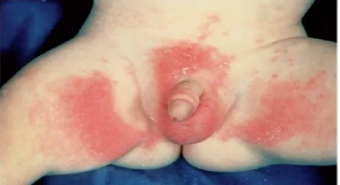 Gambar 1.  Diaper rash primer, menunjukkan efek pada kulit yang menonjol dan tidak mengenai lipatan kulit 