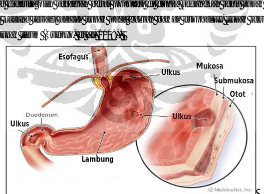 Gambar 2.1 Ulkus peptikum pada saluran gastrointestinal Esofagus Mukosa  Submukosa Otot Ulkus Ulkus Ulkus Lambung 