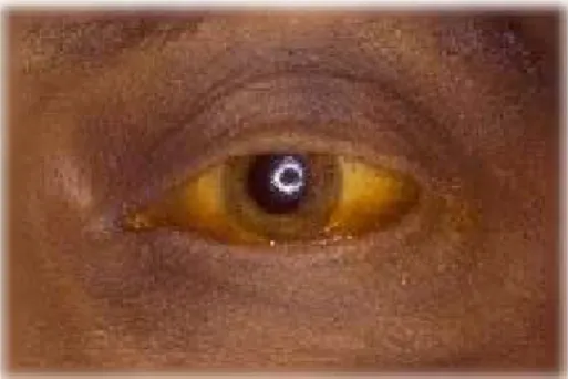 Gambar 2.5.  Fase Ikterik mata berwarna kekuning-kuningan  d.  Fase Penyembuhan. 