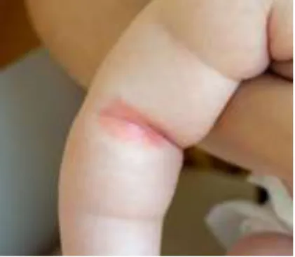 Gambar 2.2  psoriasis Vulgaris
