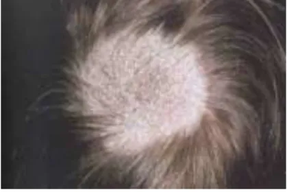Gambar 2.4 tinea kapitis 