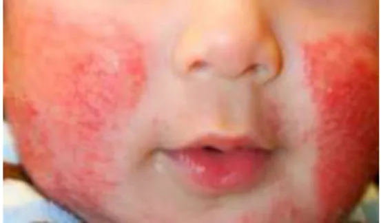 Gambar 2.5 dermatitis atopik 