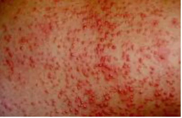 Gambar 5. Infeksi sekunder S.aureus pada  miliaria bayi (Dikutip dari kepustakaan 1) 