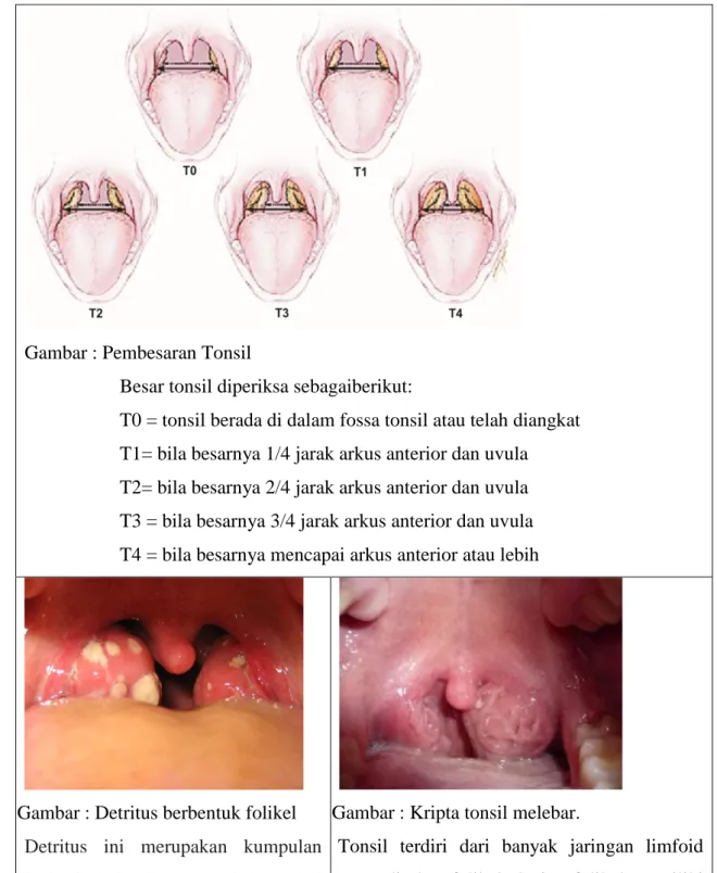 Gambar : Kripta tonsil melebar. 