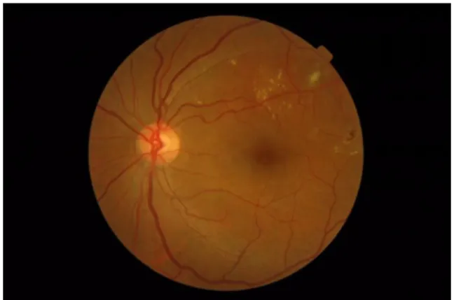 Gambar 2.2. Fundus photography 