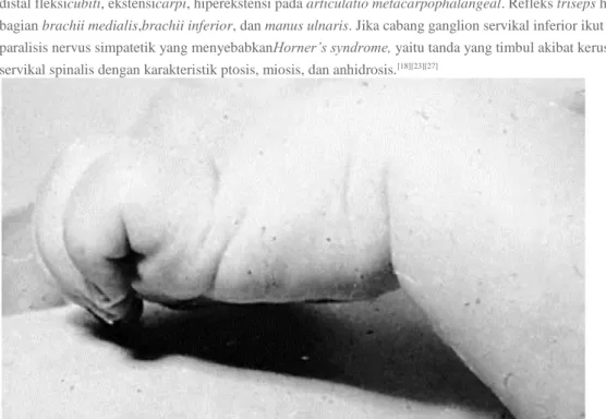 Gambar 20.Clawlike hand deformity pada Klumpke palsy. 