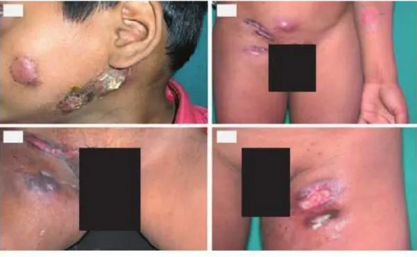 Gambar 2 Skrofuloderma 7