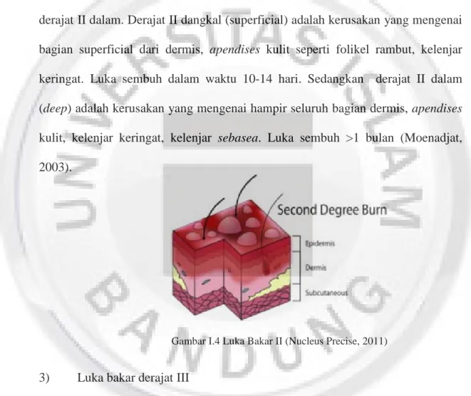 Gambar I.4 Luka Bakar II (Nucleus Precise, 2011)