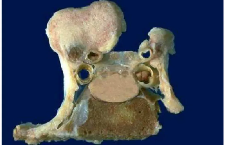 Gambar 5. Meningioma