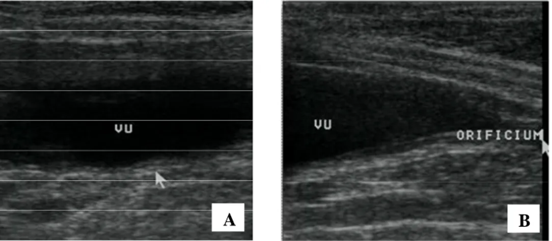 Gambar 5 Sonogram vesika urinaria normal.  (A) Pengambilan sonogram dengan  arah  transducer  transversal;  (B)  Pengambilan  sonogram  dengan  arah  transducer  sagital