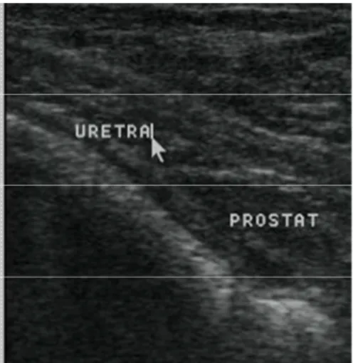 Gambar  6    Sonogram  prostat  normal  dengan  arah  transducer  sagital  bersifat  hyperechoic dan parenkim echogenic (Noviana et al