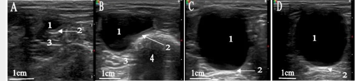 Gambar 3 Sonogram  vesika  urinaria  (VU)  kucing  kampung  sehat  posisi  transducer transversal dengan berbagai tingkatan volume akuabides