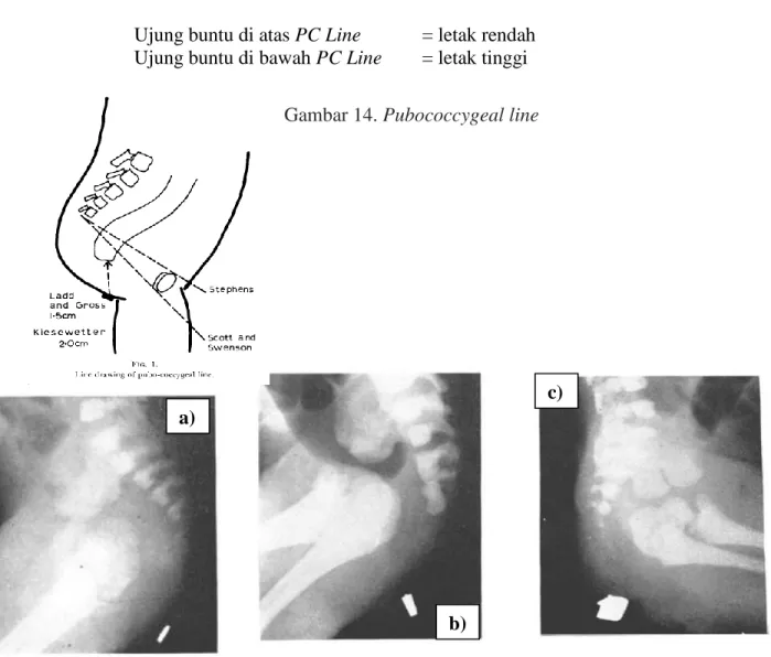 Gambar 14. Pubococcygeal line 