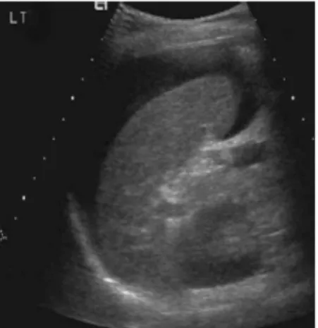 Gambar 4. USG abdomen yang menunjukkan cairan bebas peritoneum. Pada trauma tumpul  abdomen biasanya hemoperiteneum.
